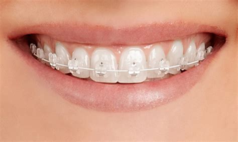 metall oder keramik brackets|keramik brackets preis.